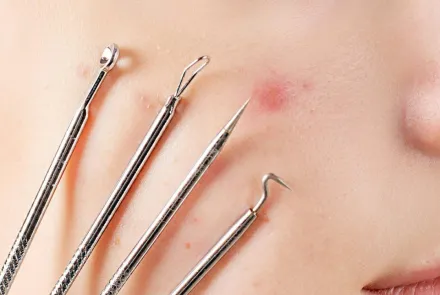 Penyebab berbagai permasalahan kulit bisa hilang dengan cara skin booster.(Foto: Pexels)